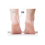 BİO SHOES Nasirx Topuk Nasir Sökücü Krem