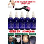 dermanew hair Dermanew Saç Losyonu Saç Bakım Yağı - Saç Gürleştirici - Sac Serumu losyon 5 Adet Roller