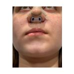 footlıne foot healthly Burun Deligi Sekillendirici 2-8 No-nostril Retainer