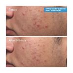 Gndz Store Murad Relief Spot Treatment - Lokal Sivilce Kurutucu Jel 1 Paket (1 x 15 Ml) - Option-1