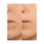Güzel Hediyem Stopever Clearly Spot Patch, Sivilce Karşıtı Şeffaf Plaster 2'li Paket | Ultra Ince, Hidrokolloid + Niacinamide + Salicylic Asit Içerikli Akne Karşıtı Yüz Bandı | 48 Adet (2 x 24) - Ahşap