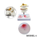 Lumbar Vertebra Disk Hernisi Omurga Modeli Model 4