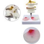 Miyang Lumbar Vertebra Disk Hernisi Omurga Modeli Model 4
