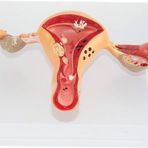 Rahim Lezyon Modeli - Kadın İç ve Dış Organları Anatomik Modeli - Pvc İnsan Anatomisi Sciee Modelleri - Jinekoloji Eğitim Yardımı Tıbbi Eğitim Modeli