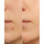 Stopever Clearly Spot Patch, Sivilce Karşıtı Şeffaf Plaster | Şeffaf, İnce, Hidrokolloid + Niacinamide + Salicylic Asit İçerikli Akne Karşıtı Yüz Bandı | 24 Adet