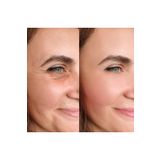 AKOLİFE Facelift Buckle -botox Clasp- Face Lift Tape (BLACK) - Yüz Germe Kaş Kaldırma Bandı