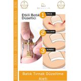 Denguva #TırnakDüzeltici Profesyonel Ayak Bakım Aparatı Ev Tipi Etkili Tırnak Çıkartıcı Batık Tırnak Düzelti