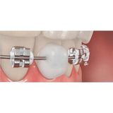 Dentalsepet Ortodontik Wax Diş Teli Mumu 5 Sıra Blok Mum ile Ağız Yaralarını Önler
