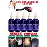 dermanew hair Dermanew Saç Losyonu Saç Bakım Yağı - Saç Gürleştirici - Sac Serumu losyon 5 Adet Roller