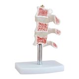 EgeAnatomi Maketleri Bel Omurga Kemik Maket Osteoporoz Anatomik Modeli 16X12X10 cm