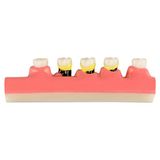 EgeAnatomi Maketleri Periodontal Hastalık Sınıflandırma Modeli - Diş Maketi - 15 x 3 x 5cm