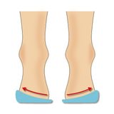 ICEMEN 505 Silikon Topukluk, İçe ve Dışa Basma Düzeltici, 4 Beden (XS-L),%100 Silikon Yapı (XS (30-33))