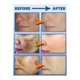 KAİZEN Çil - Güneş Yanığı - Kloazma - Radyasyon Noktaları - - Cyasma Giderici Krem