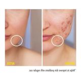 Leke Karşıtı ve Gözenek Sıkılaştırıcı Krem, 200 ml Niacinamide ile
