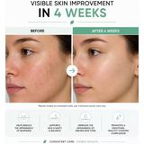 Lexroo Azelaik Asit Serumu Niacinamide & Çinko ile 30ML