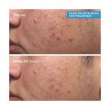 Murad Relief Spot Treatment - Lokal Sivilce Kurutucu Jel 1 Paket (1 x 15 Ml) - Option-1
