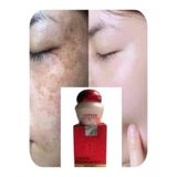 Qingzhimei %100 7 Günde Etkii Kore Kremi Melazma, Çil, , Güneş Lekeleri, Koyu Halka Giderme, 25Grm