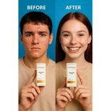 Sanjana Beauty Anti Acne Serum 10 Ml , Akne Karşıtı, Sivilce Kurutucu, Cilt Arındırıcı Serum