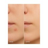 TeknoKapsül Stopever Clearly Spot Patch, Sivilce Karşıtı Şeffaf Plaster 2'li Paket | Ince, Hidrokolloid +
