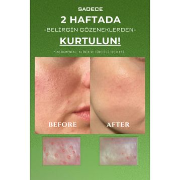 Acqua Perfection Derma Pure Arındırıcı ve Gözenek Sıkılaştırıcı Siyah Nokta Akne Soyulabilir 70 ml Yüz Maskesi