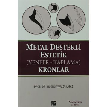 METAL DESTEKLI ESTETIK (VENEER - KAPLAMA) KRONLAR - HÜSNÜ YAVUZYILMAZ